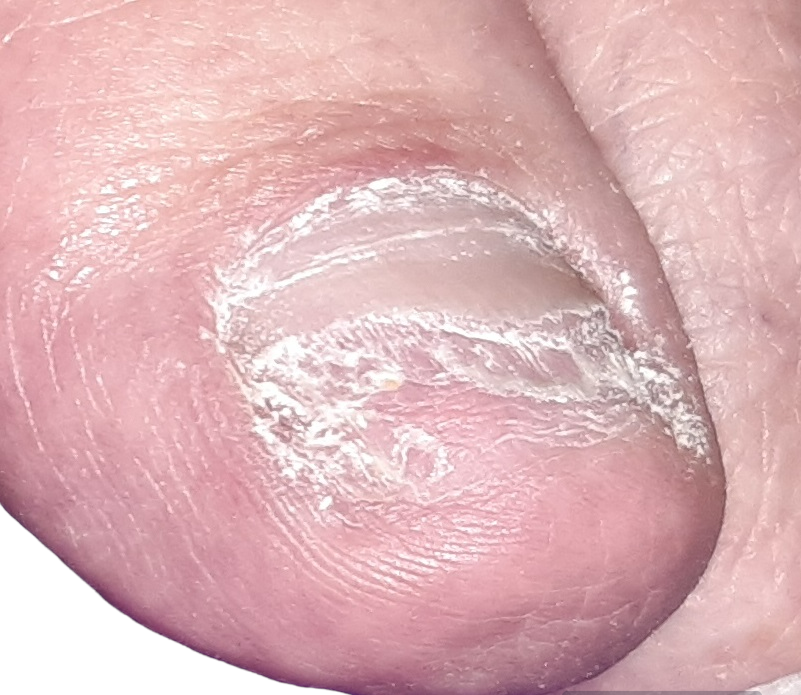 Toenail reconstruction Pedicure&Manicure